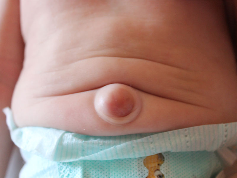 hernia-foto2